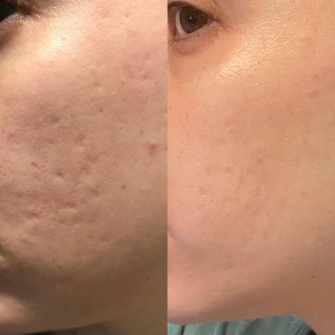 Tolvos™ - Silikonové plátky na jizvy