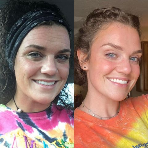 Tolvos™ - Silikonové plátky na jizvy